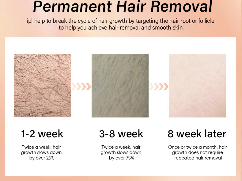 KODO 2025 High-end customization ice Laser Hair removal Laser Epilator Permanent IPL Painless Photoepilator 4 in 1 face and body.