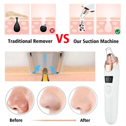 Newest Technology Blackhead Remover Vacuum Pore Cleaner for Face&Nose Blackhead Removal Kit Electric Acne Facial Extractor Tool.